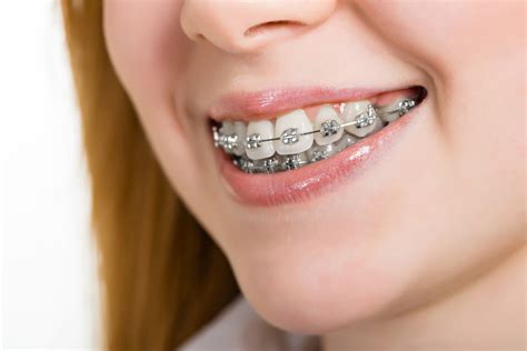 cuales son los brackets metalicos|brackets metalicos.